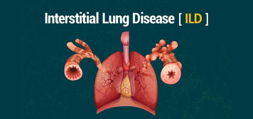 ILD (Interstitial Lung Disease) Expert Opinion